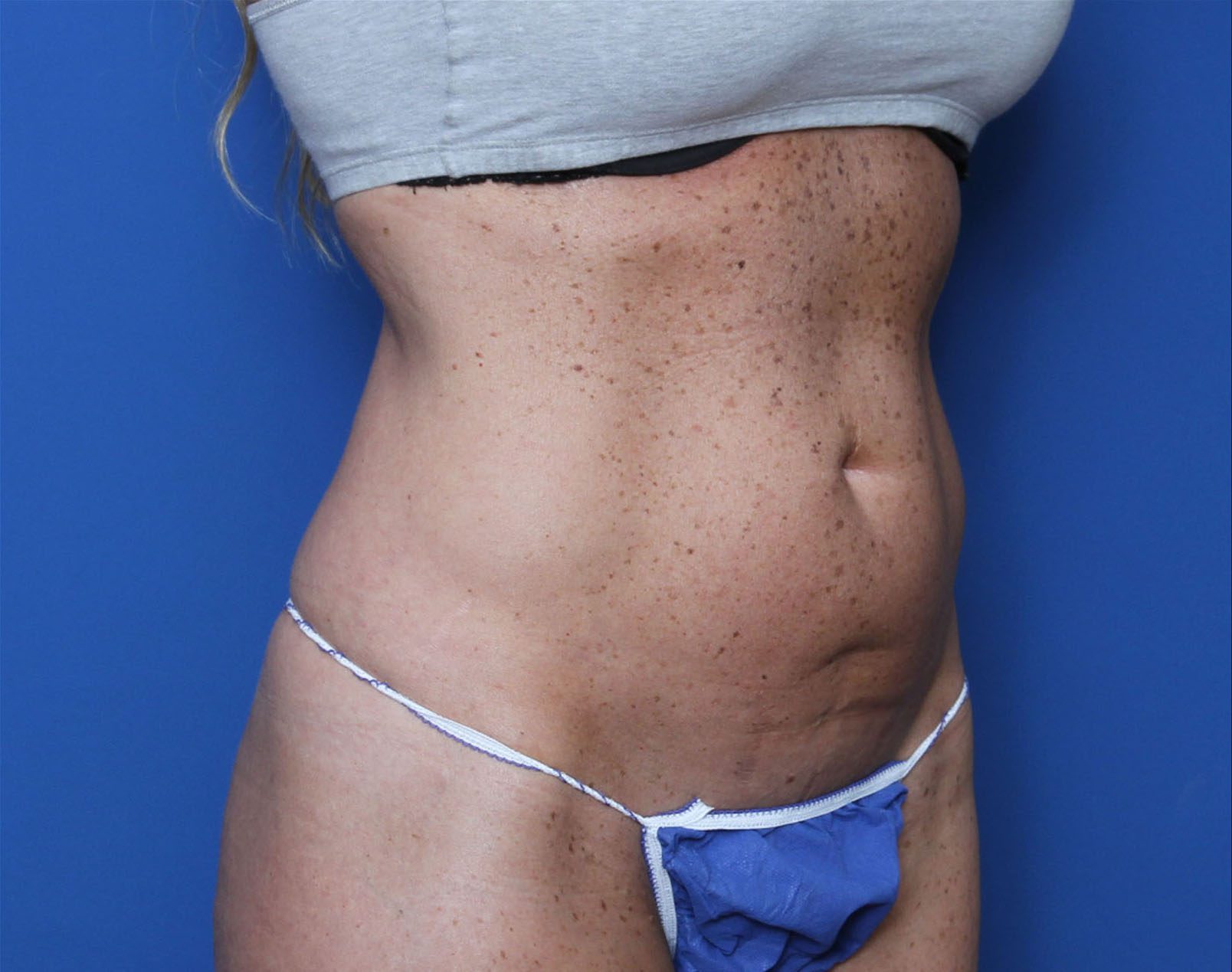 Liposuction Patient Photo - Case 7383 - before view-1