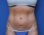 Liposuction - Case 7383 - Before