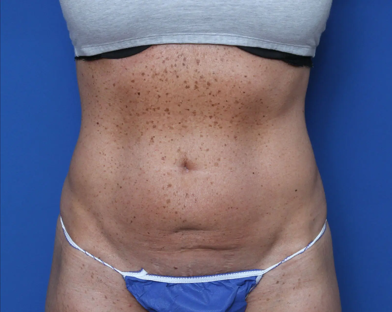 Liposuction Patient Photo - Case 7383 - before view-