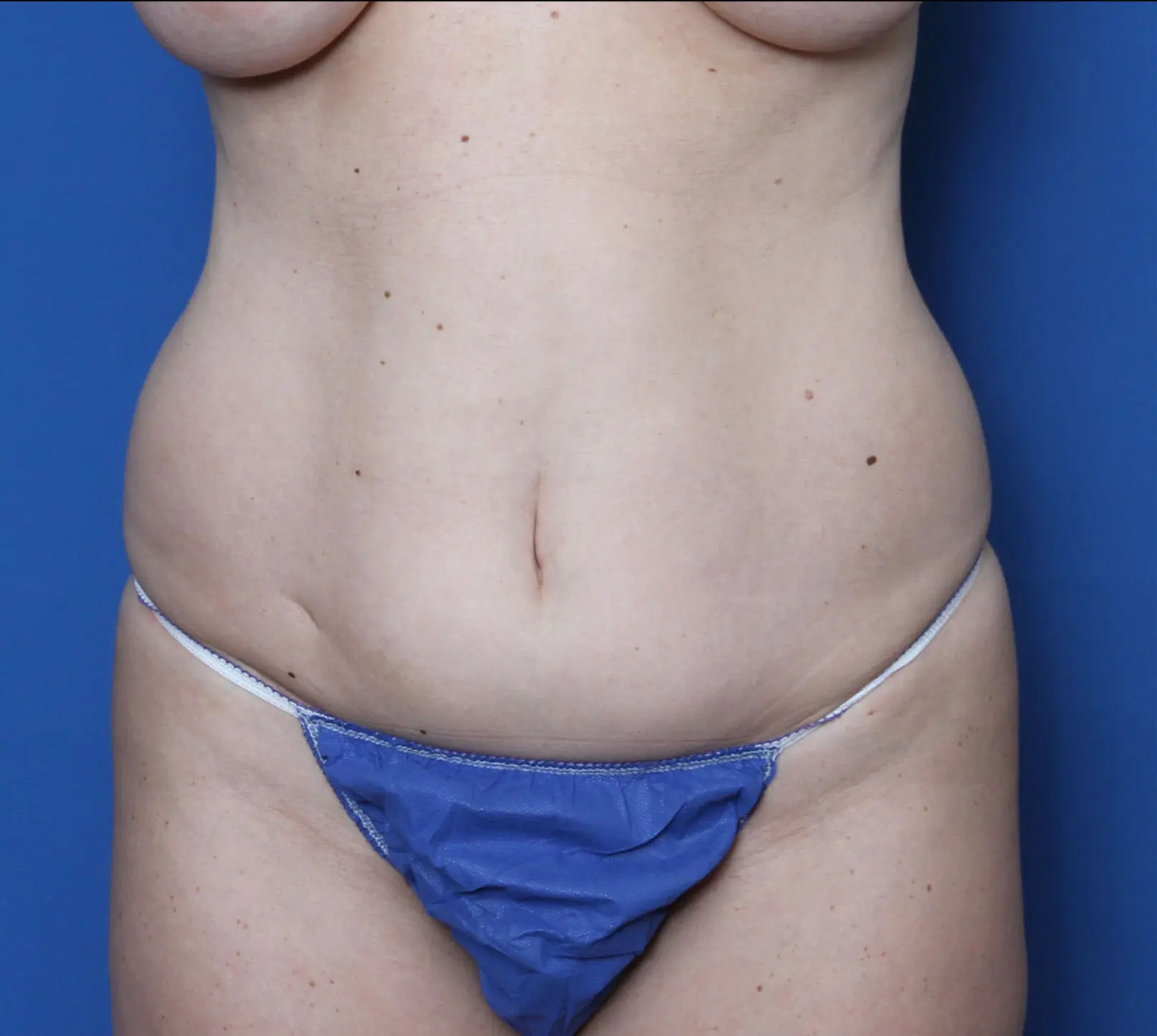 Liposuction Patient Photo - Case 3394 - before view-