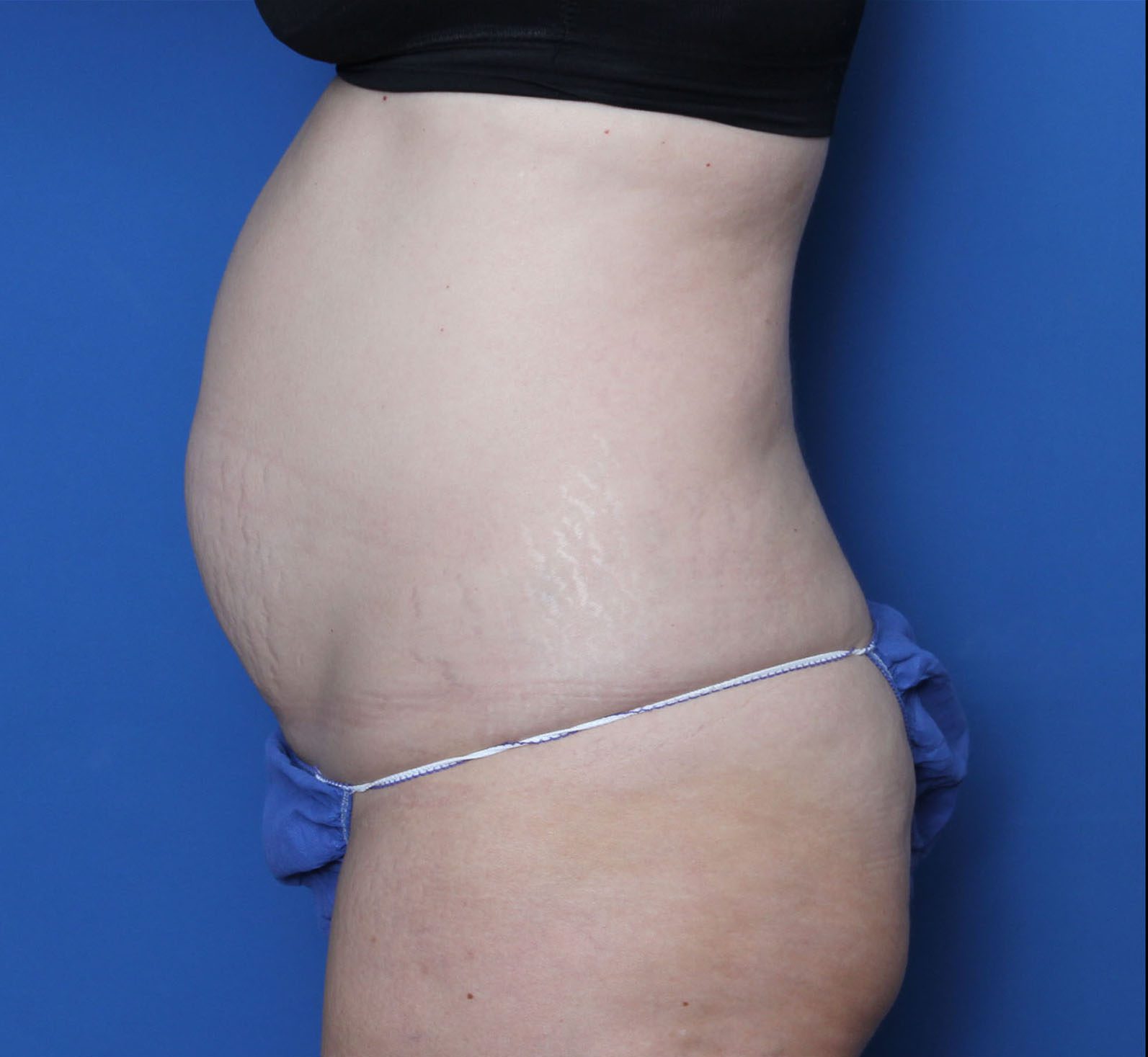 Liposuction Patient Photo - Case MM5325 - before view-2