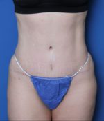 Liposuction - Case MM5325 - After