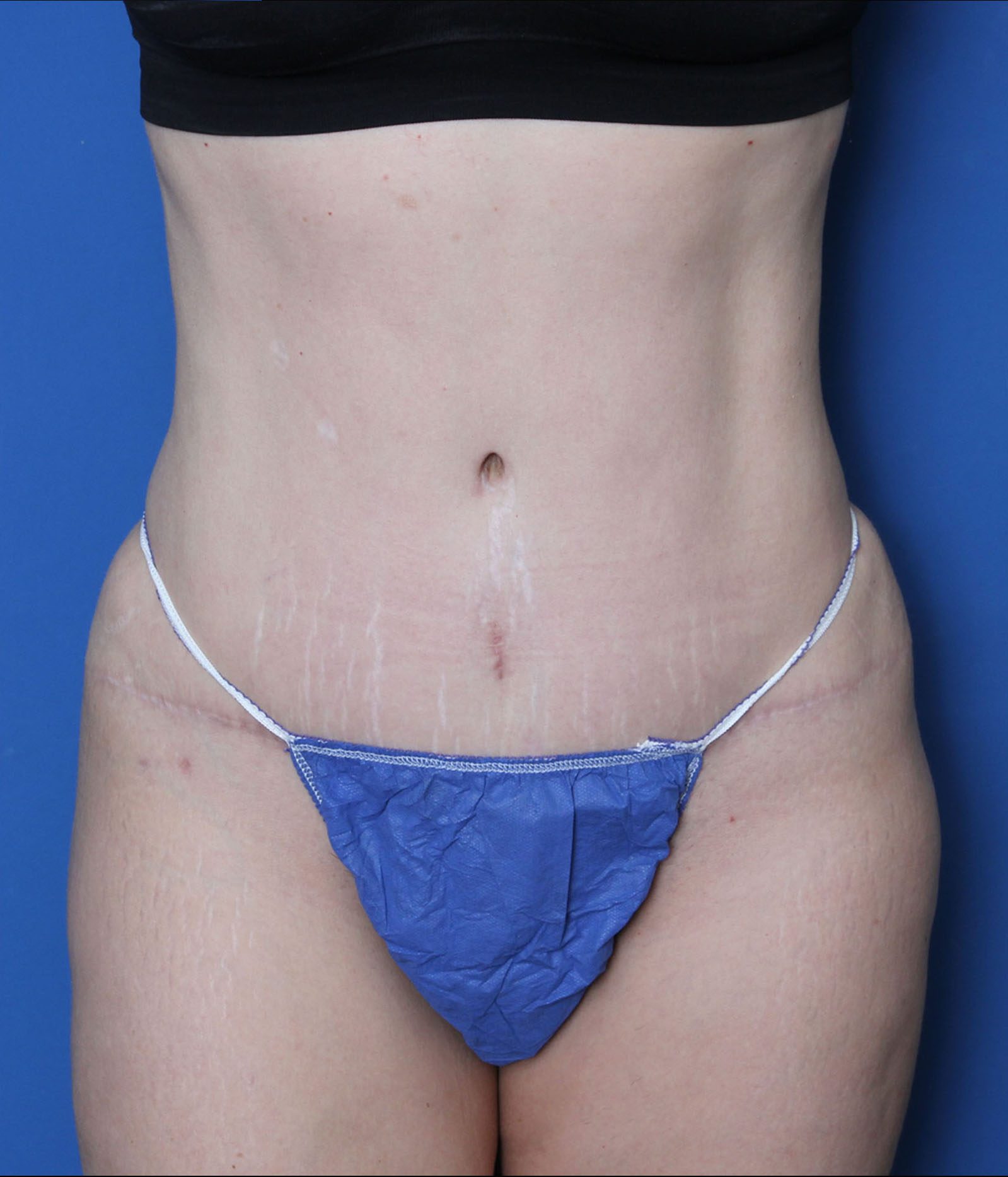 Liposuction Patient Photo - Case MM5325 - after view-0
