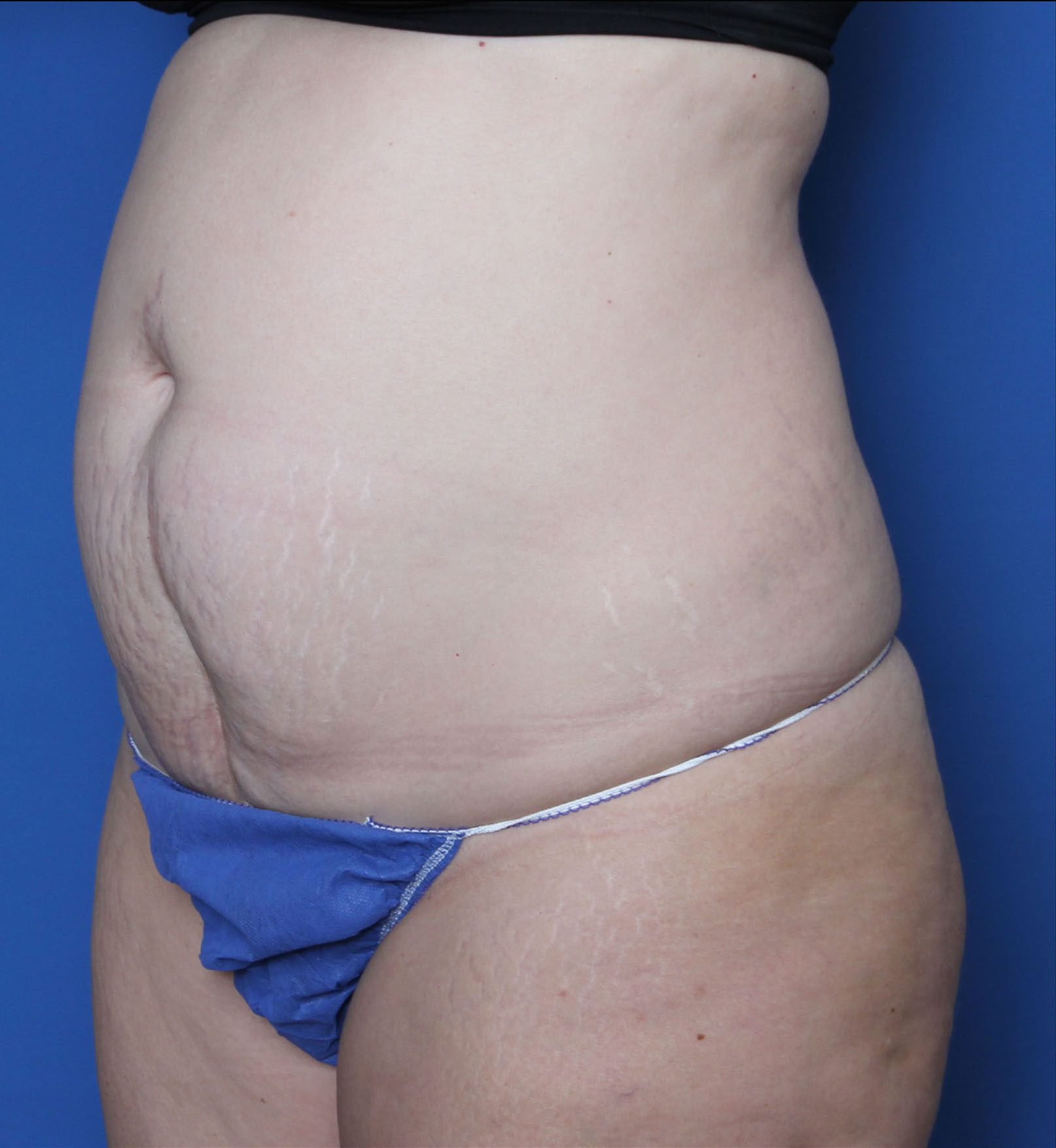 Liposuction Patient Photo - Case MM5325 - before view-1