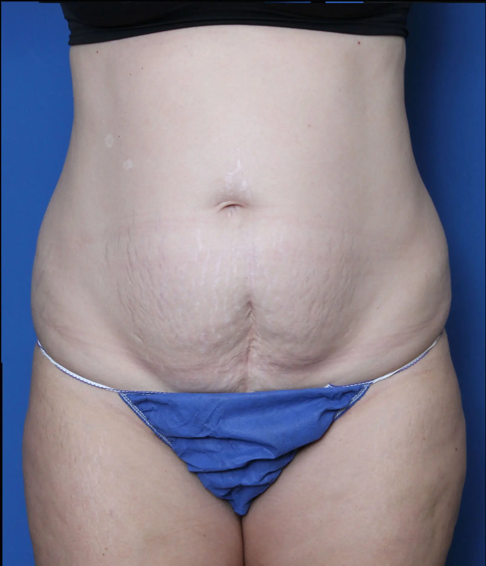 Liposuction Patient Photo - Case MM5325 - before view-