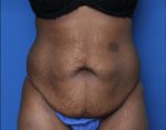 Liposuction - Case 5339 - Before