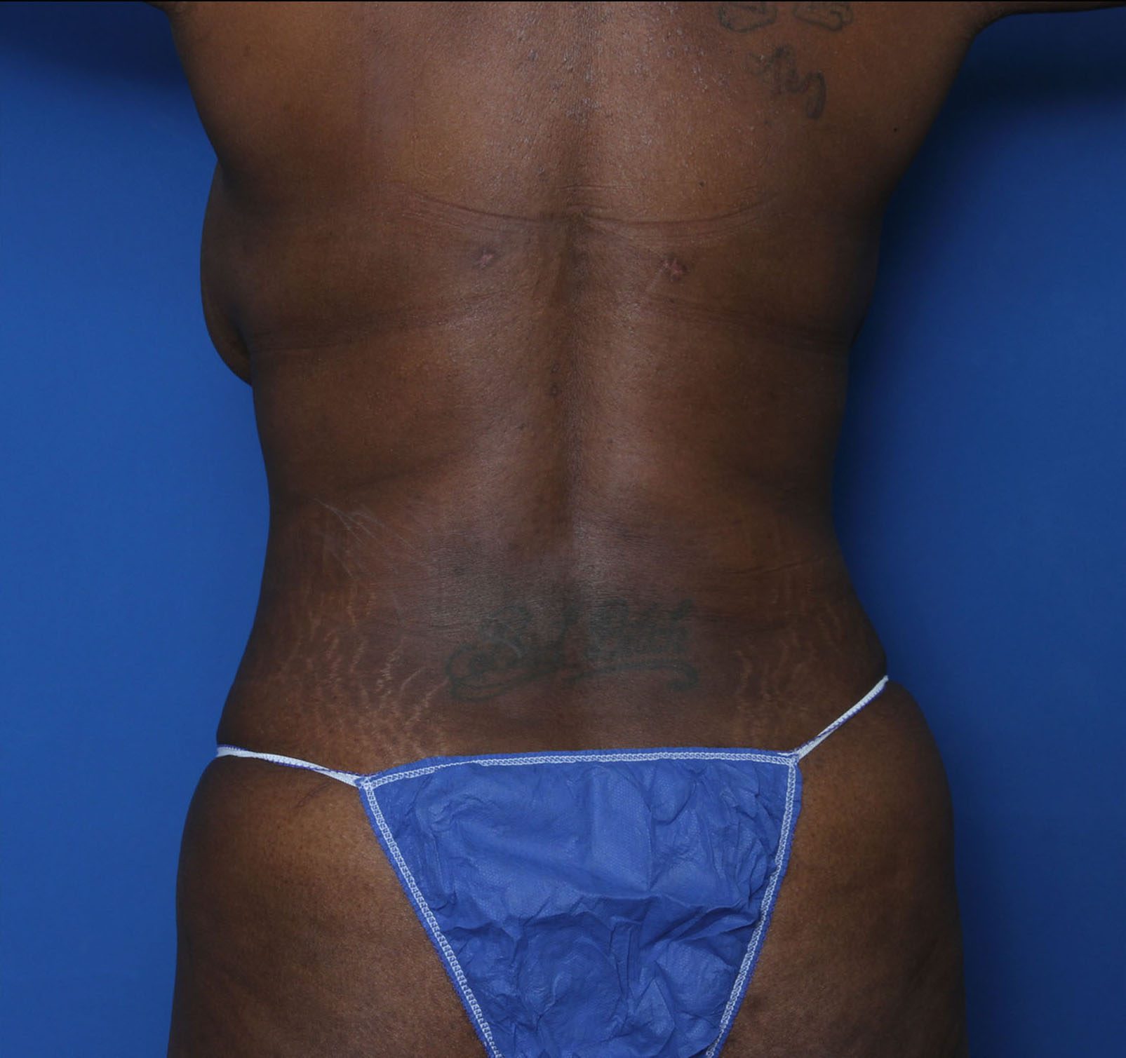 Liposuction Patient Photo - Case 5339 - after view-3