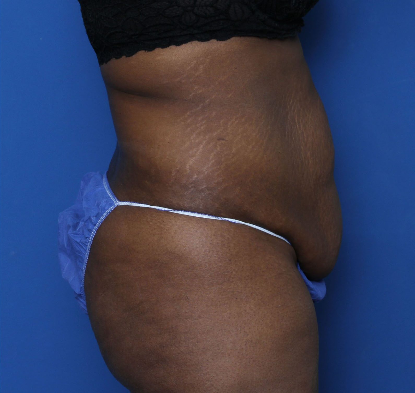 Liposuction Patient Photo - Case 5339 - before view-2