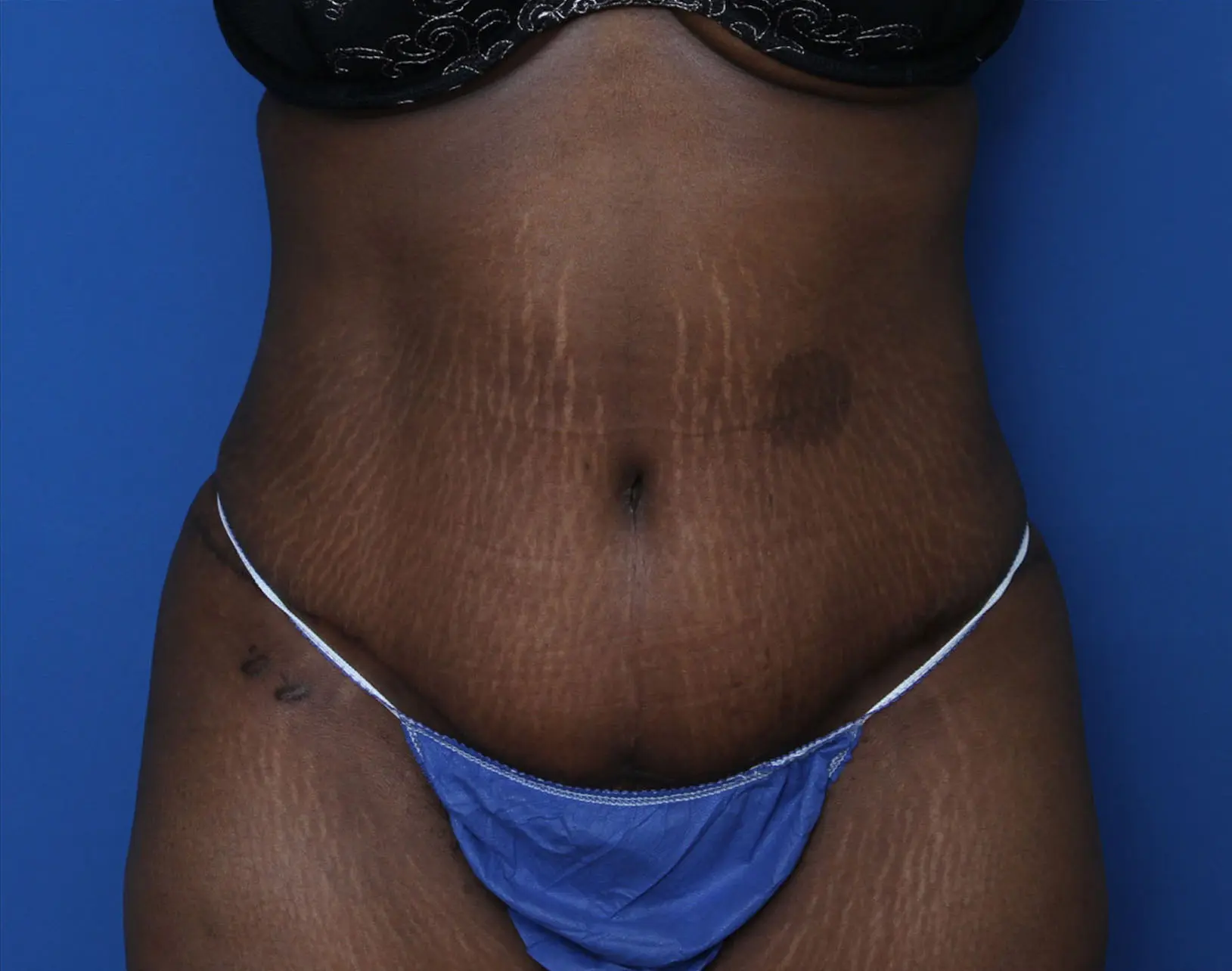 Liposuction Patient Photo - Case 5339 - after view