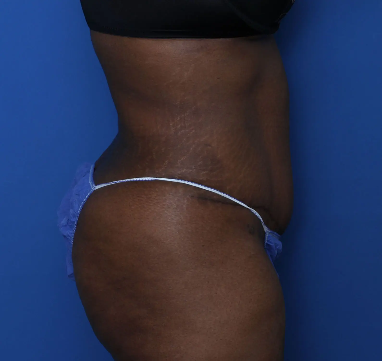 Liposuction Patient Photo - Case 5339 - after view-2