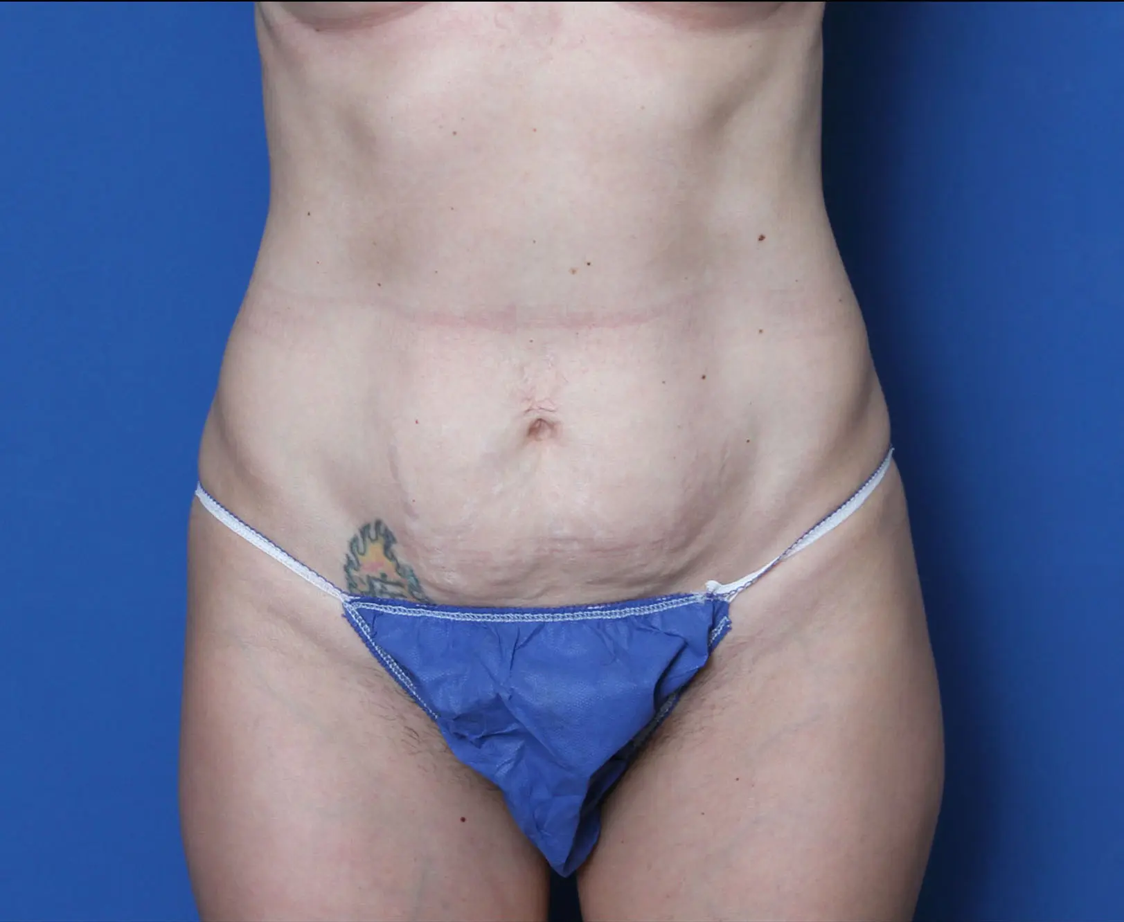 Tummy Tuck Patient Photo - Case 5218 - before view-