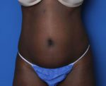 Tummy Tuck - Case MM5826 - Before