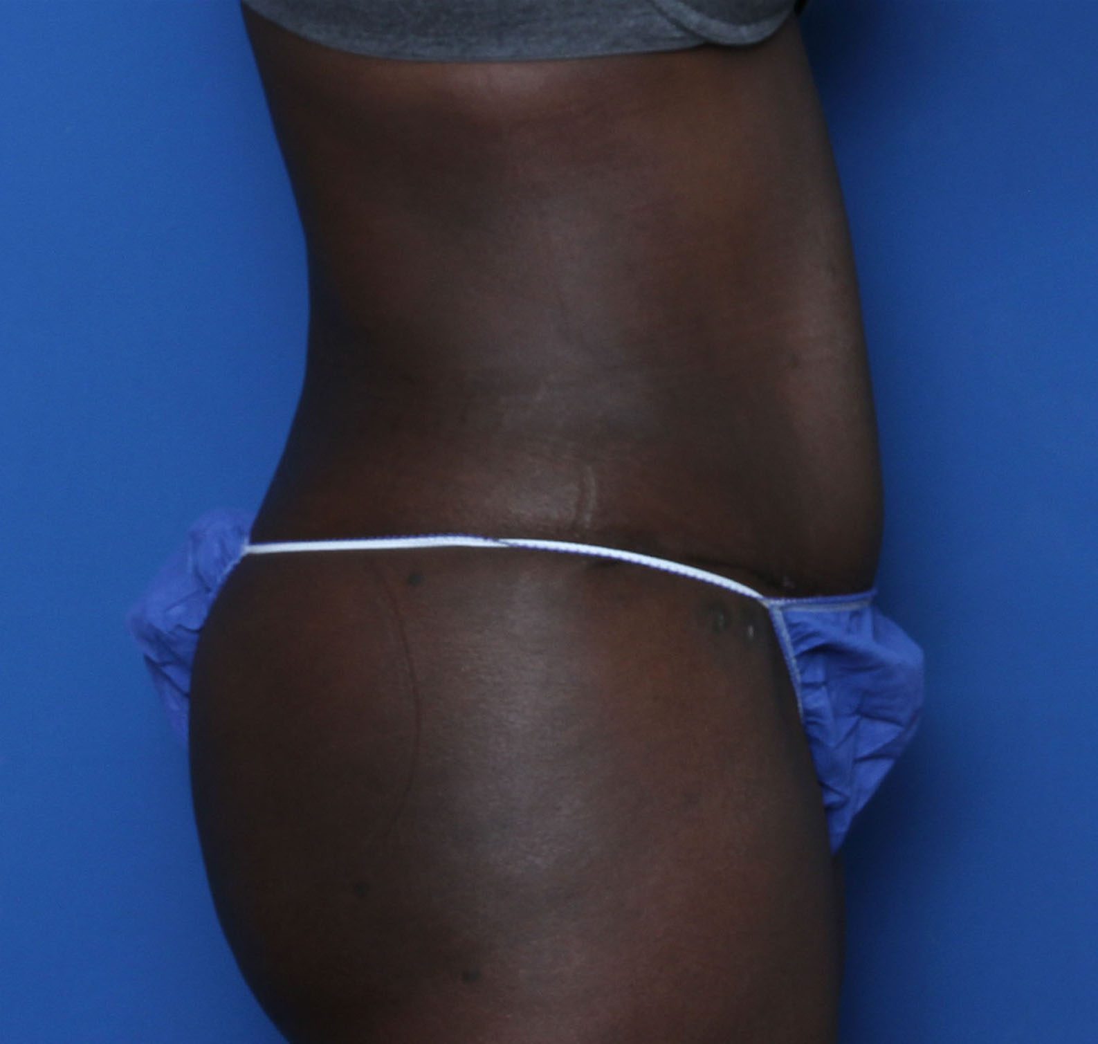 Tummy Tuck Patient Photo - Case MM5826 - after view-2