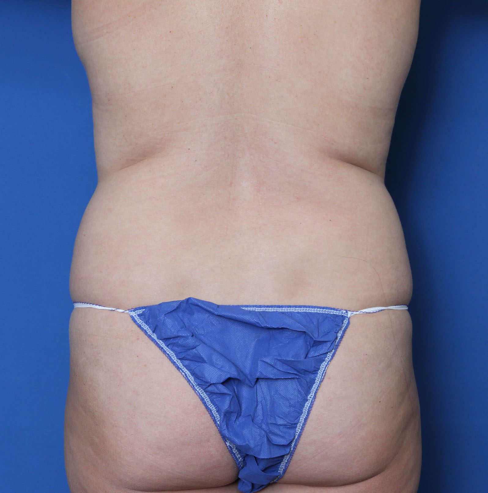 Liposuction Patient Photo - Case MM1068 - before view-3