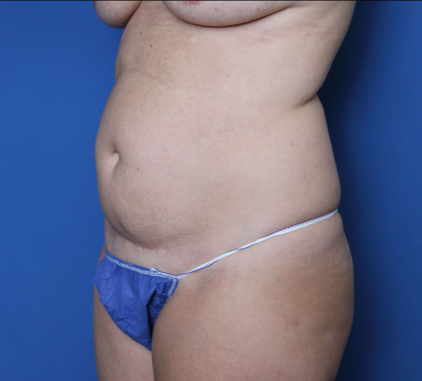 Liposuction Patient Photo - Case MM1068 - before view-1