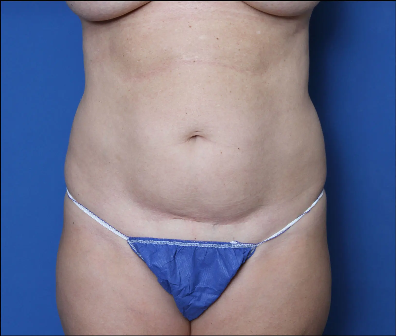 Liposuction Patient Photo - Case MM1068 - before view-0