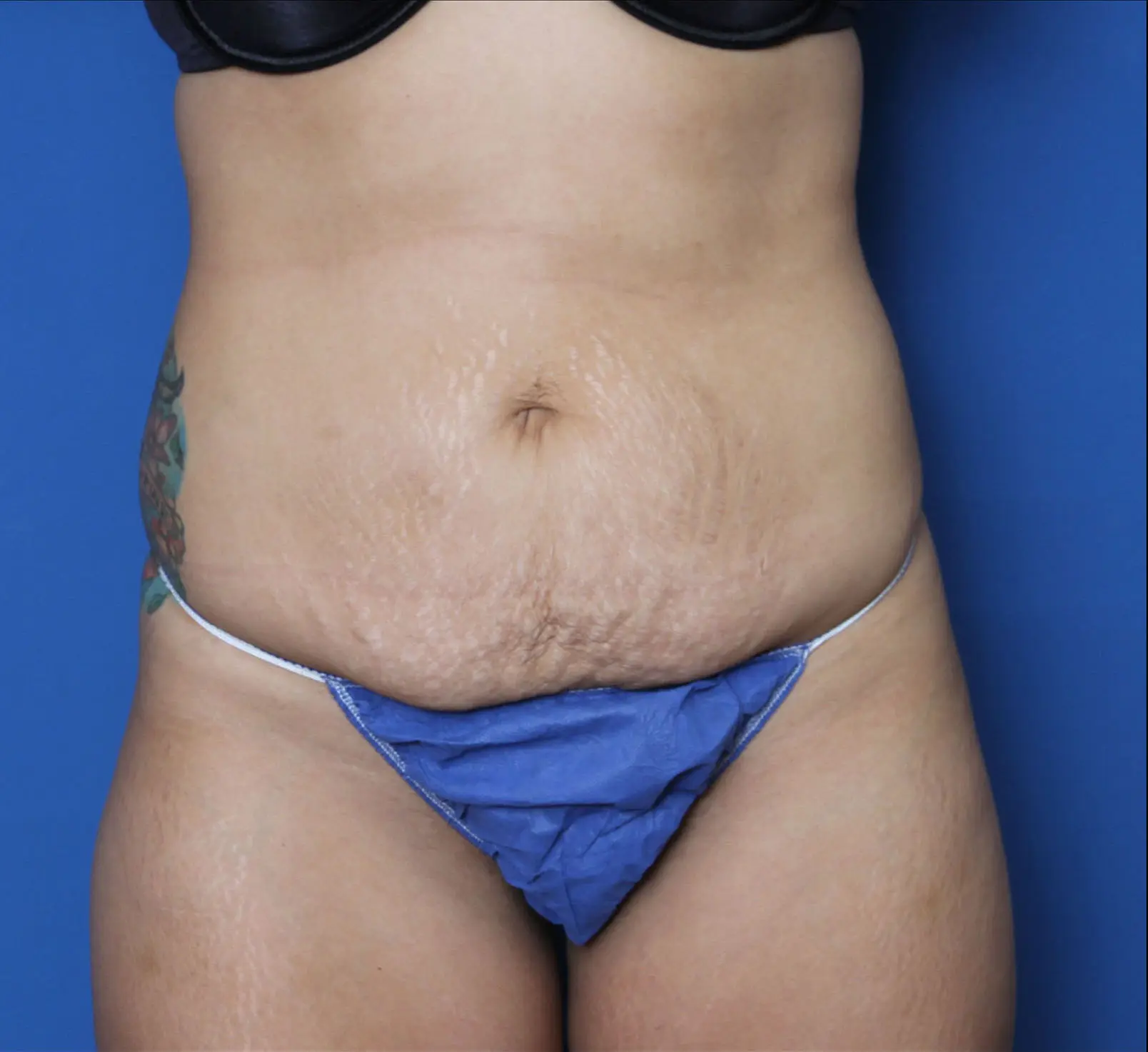 Tummy Tuck Patient Photo - Case MM5710 - before view-0
