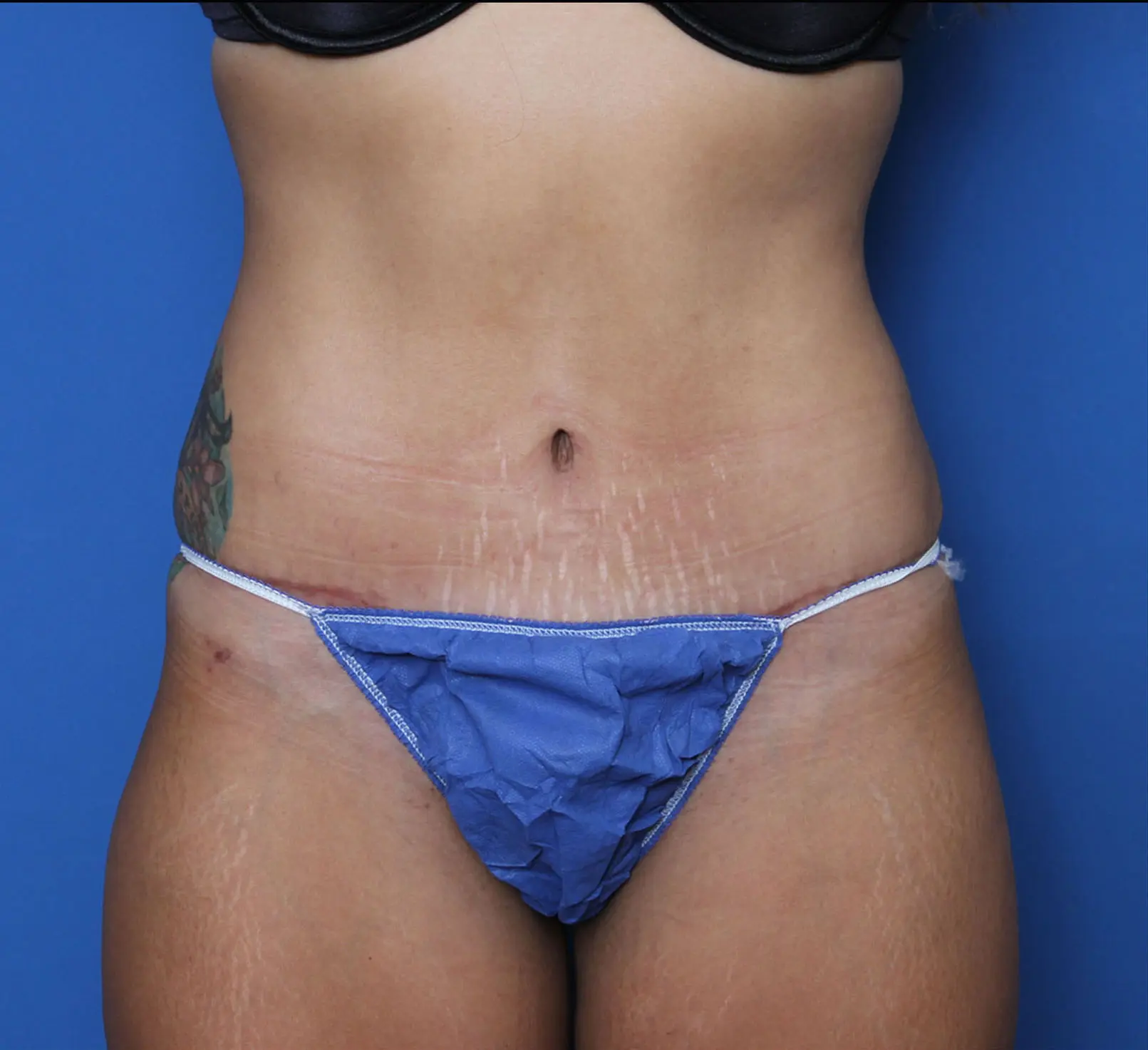 Tummy Tuck Patient Photo - Case MM5710 - after view