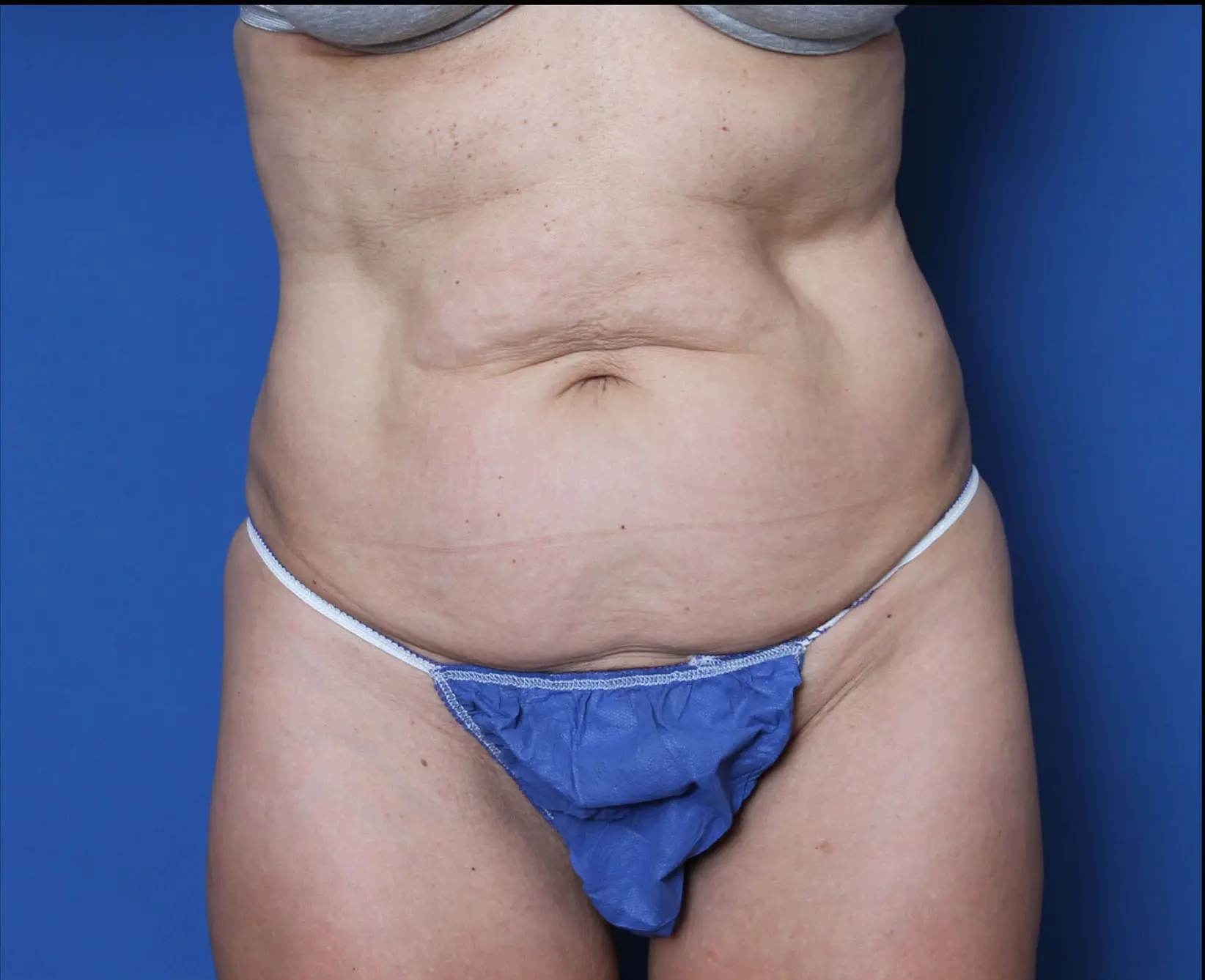 Liposuction Patient Photo - Case MM0419 - before view-