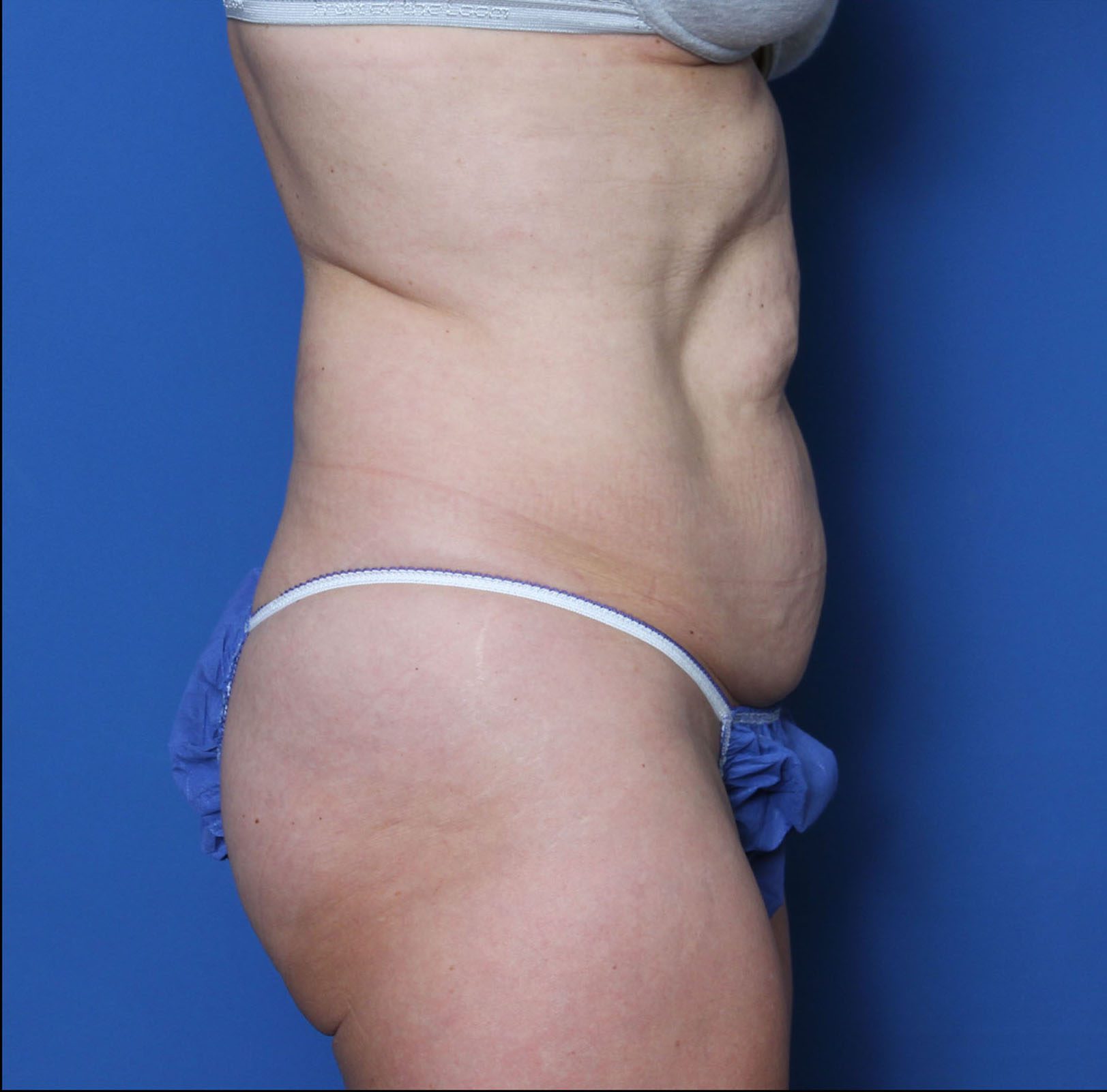 Liposuction Patient Photo - Case MM0419 - before view-1