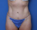 Liposuction - Case MM0419 - After