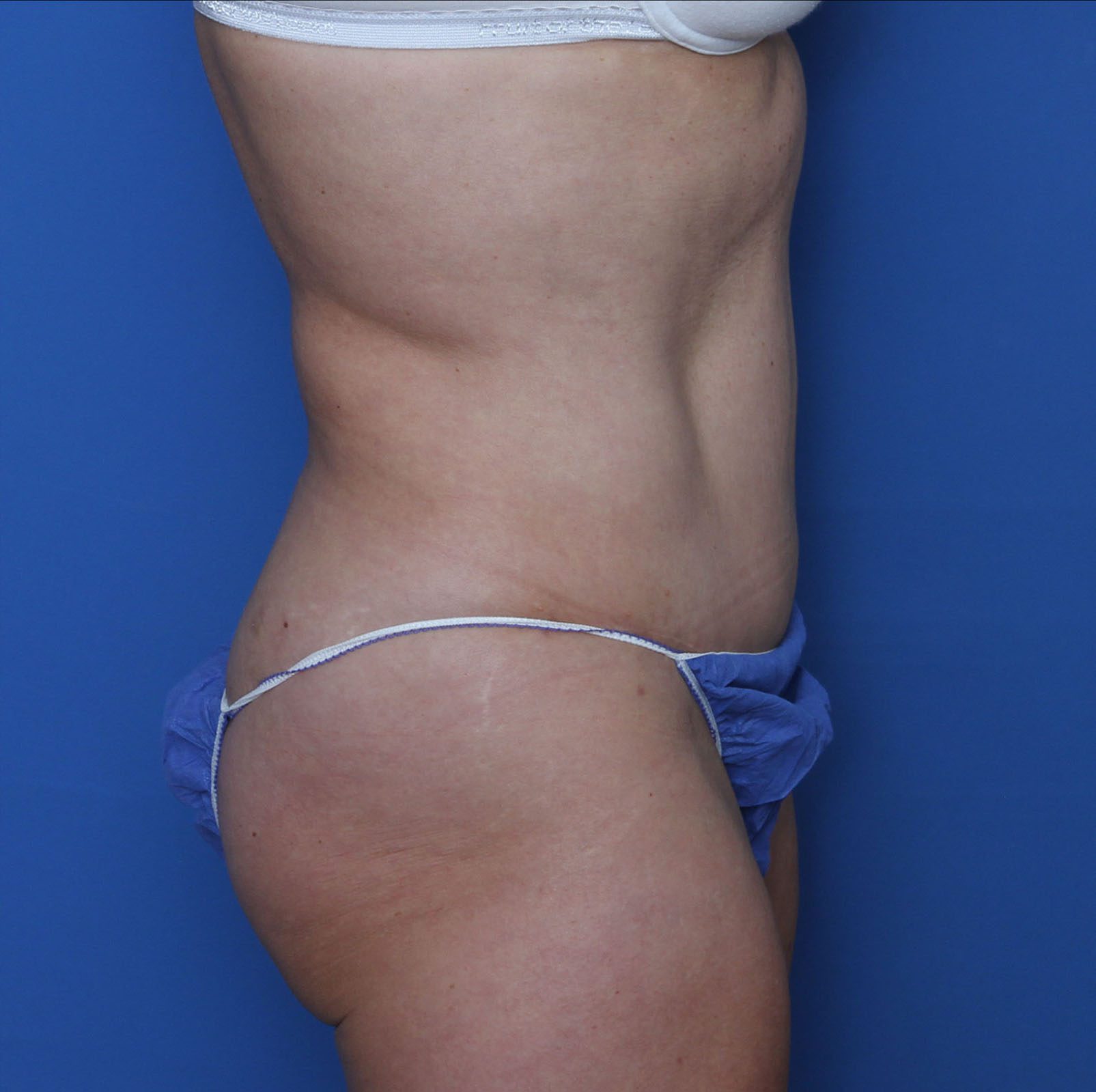 Liposuction Patient Photo - Case MM0419 - after view-1