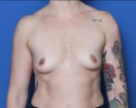 Breast Augmentation - Case MM5578 - Before