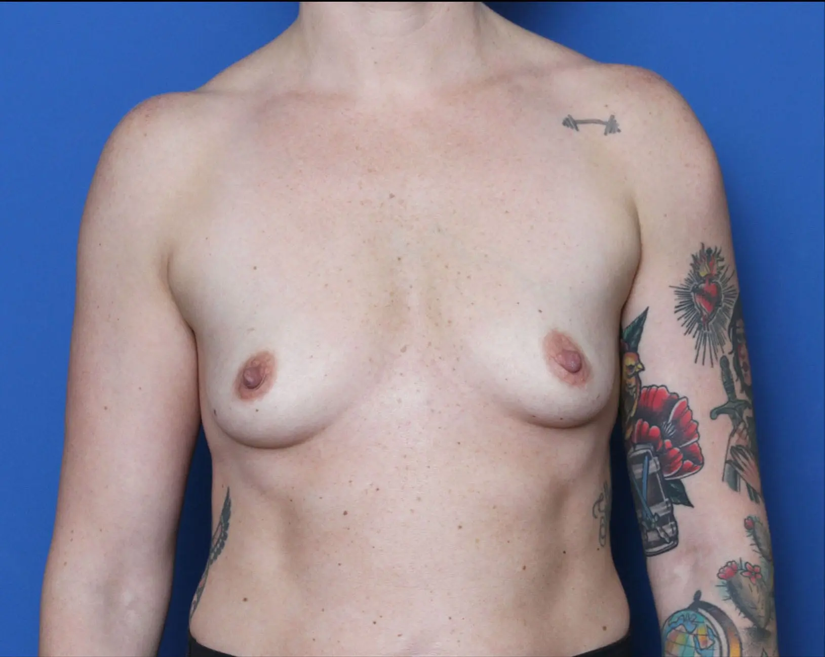 Breast Augmentation Patient Photo - Case MM5578 - before view-