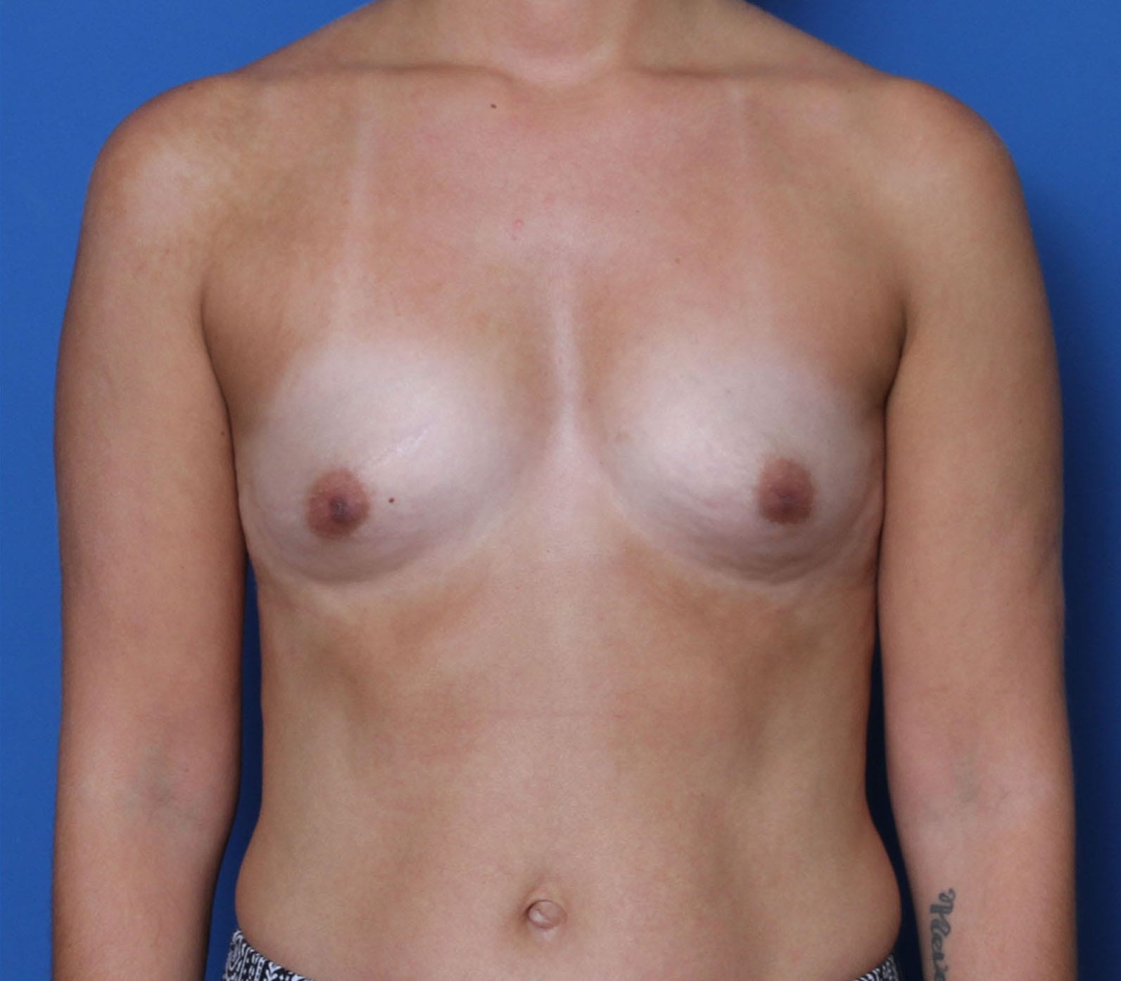 Breast Augmentation Patient Photo - Case MM5215 - before view-