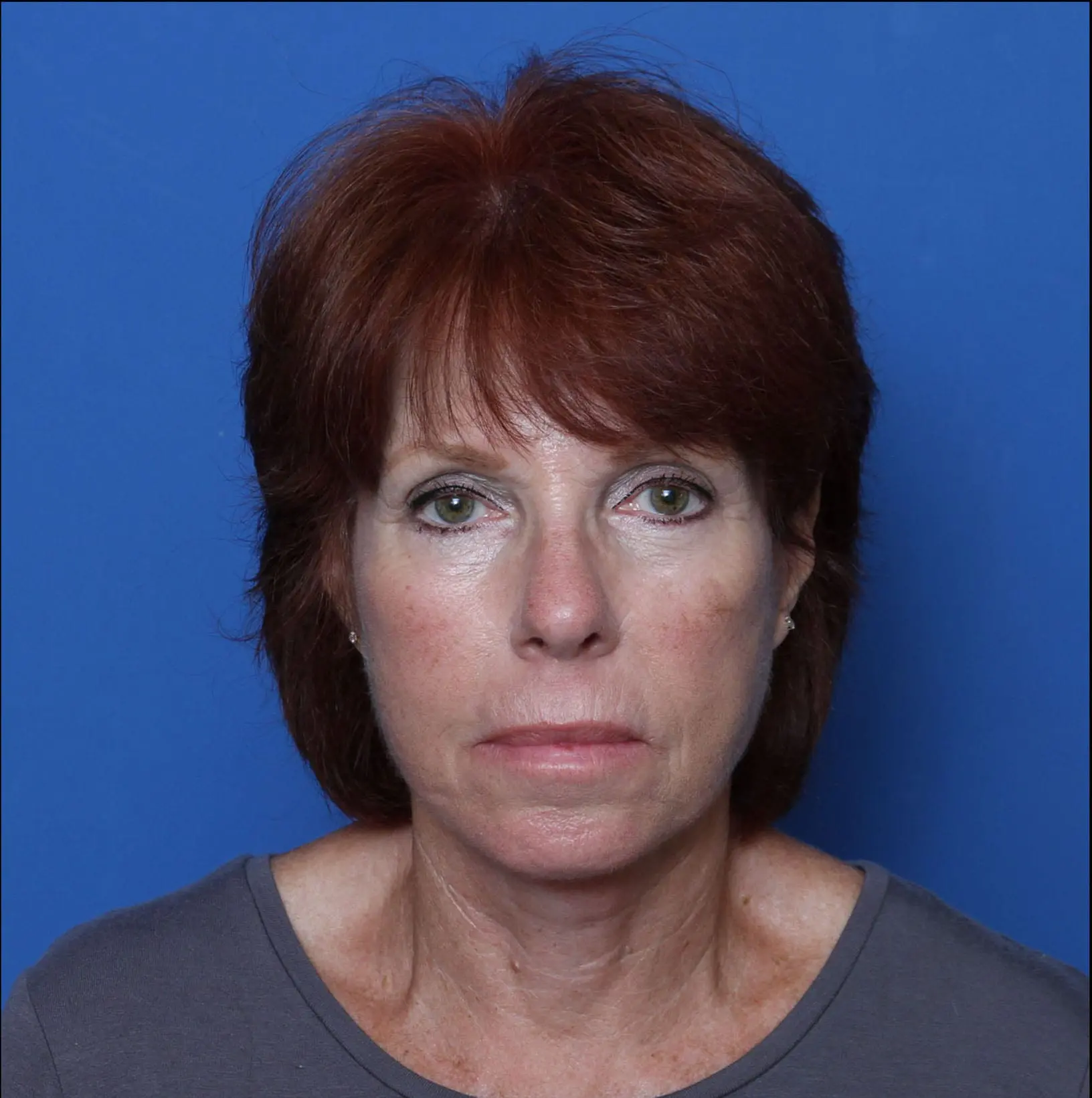Facelift Patient Photo - Case MM5201 - after view