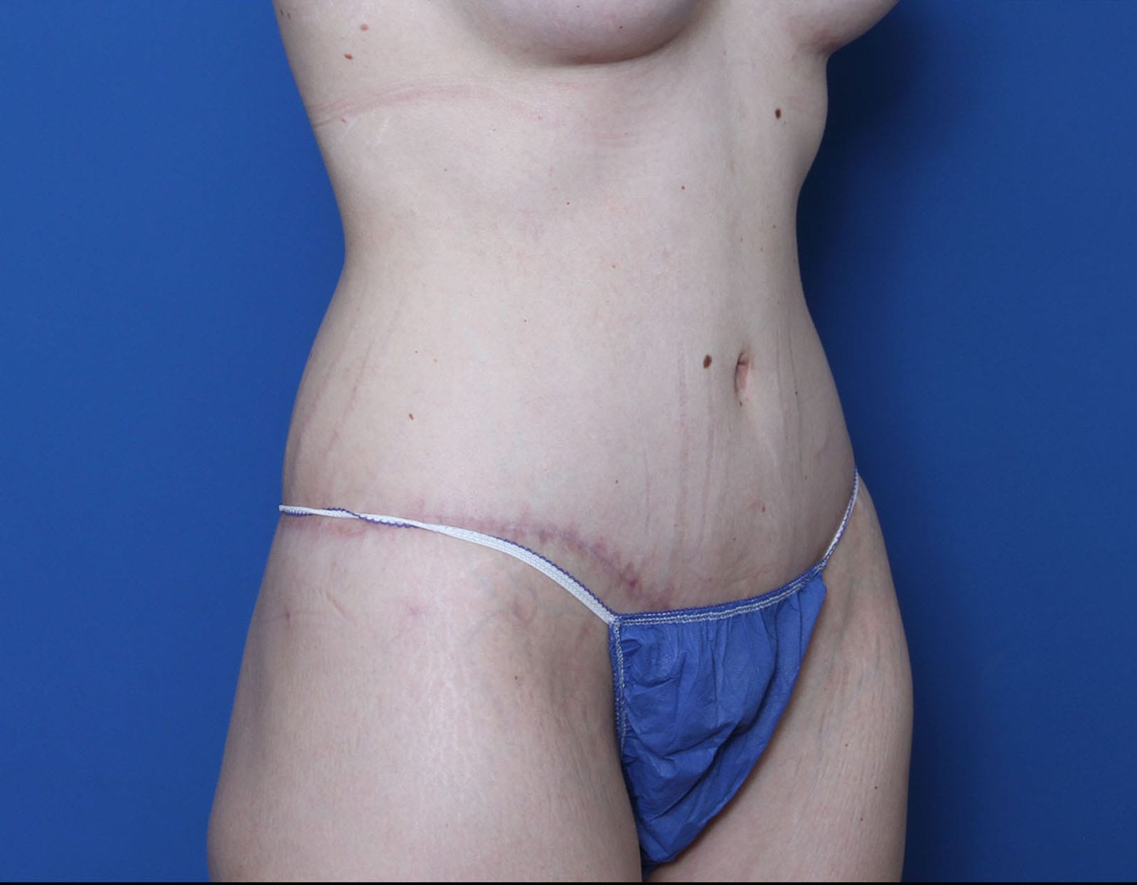 Belt Lipectomy Patient Photo - Case MM5826 - after view-1