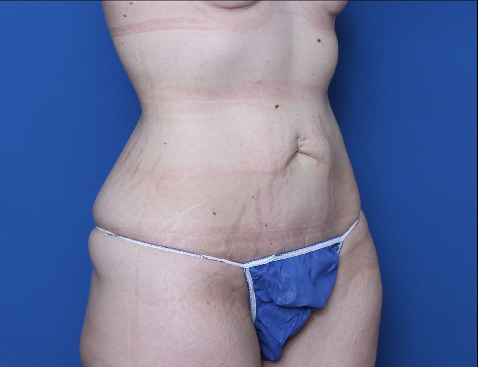 Belt Lipectomy Patient Photo - Case MM5826 - before view-1