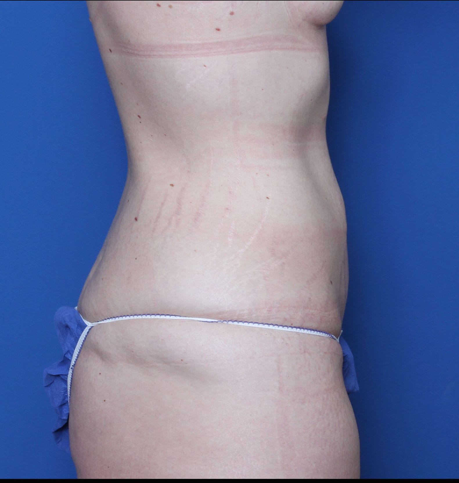 Belt Lipectomy Patient Photo - Case MM5826 - before view-2