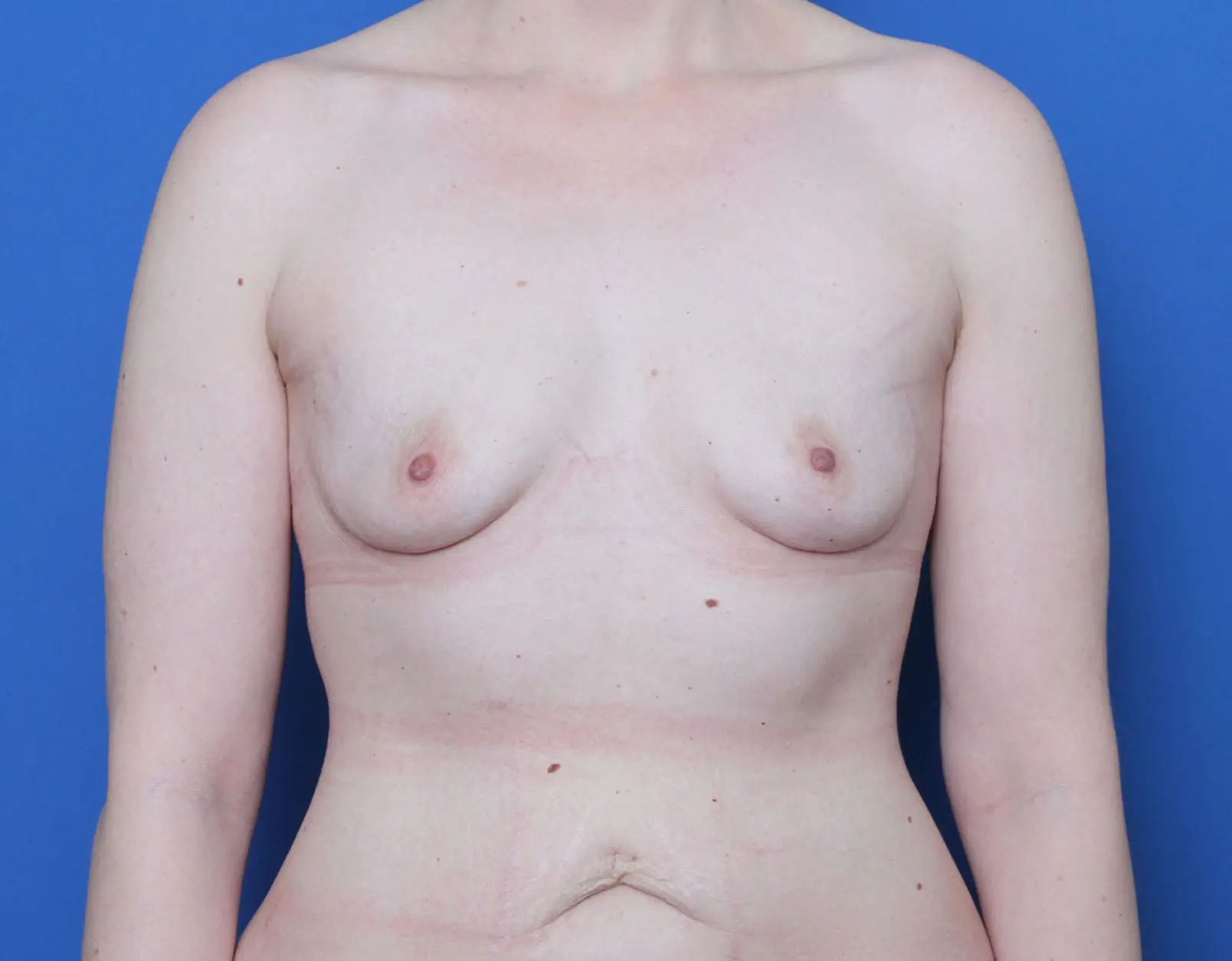 Breast Augmentation Patient Photo - Case 6077 - before view-