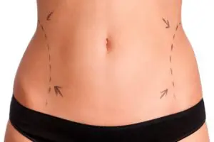 Closeup of a woman's abdomen getting drawn on before her liposuction procedure.