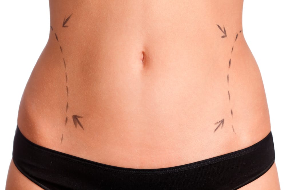 Can Liposuction Give You an Hourglass Figure?