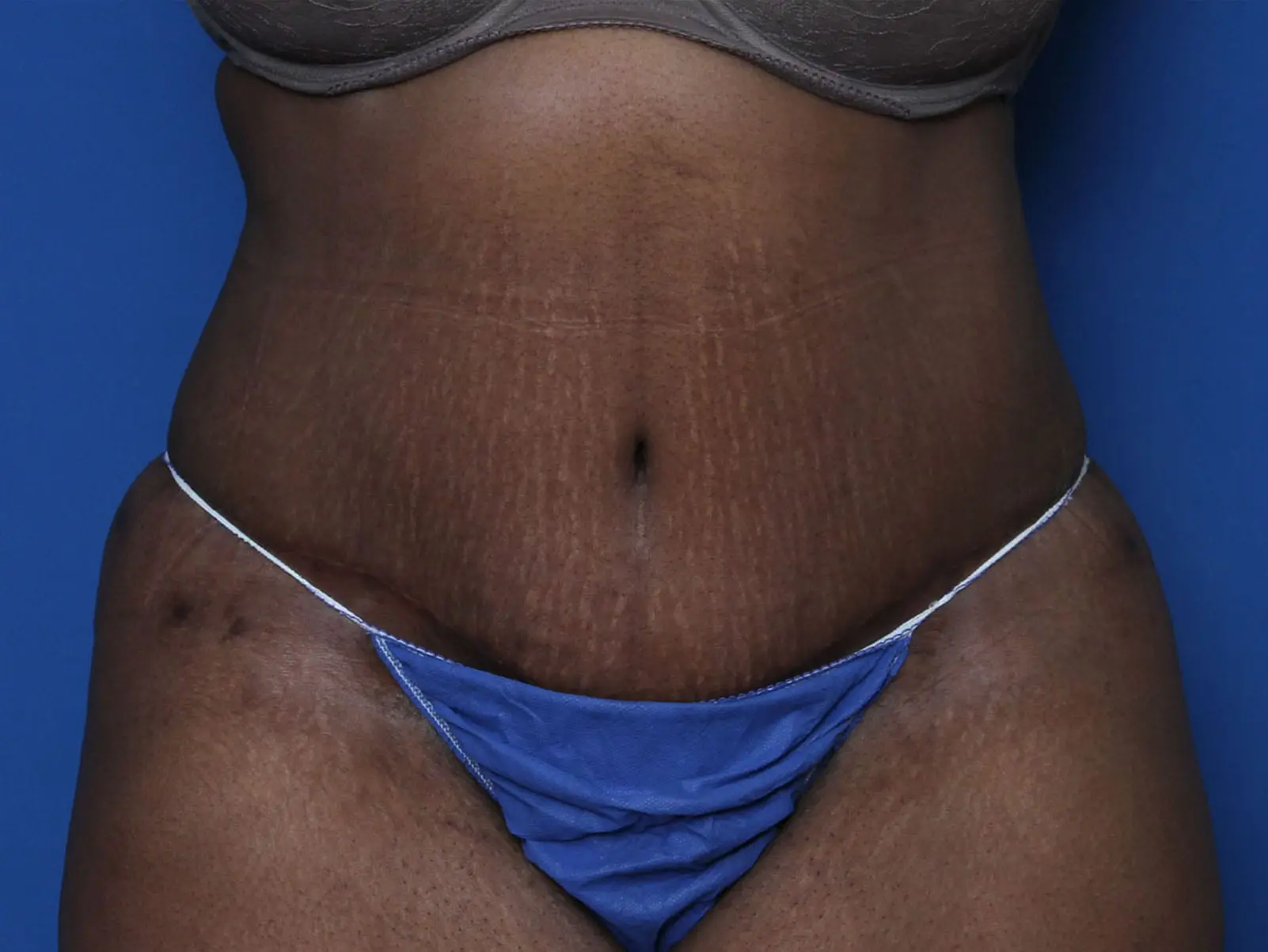Belt Lipectomy Patient Photo - Case MM1110 - after view-0