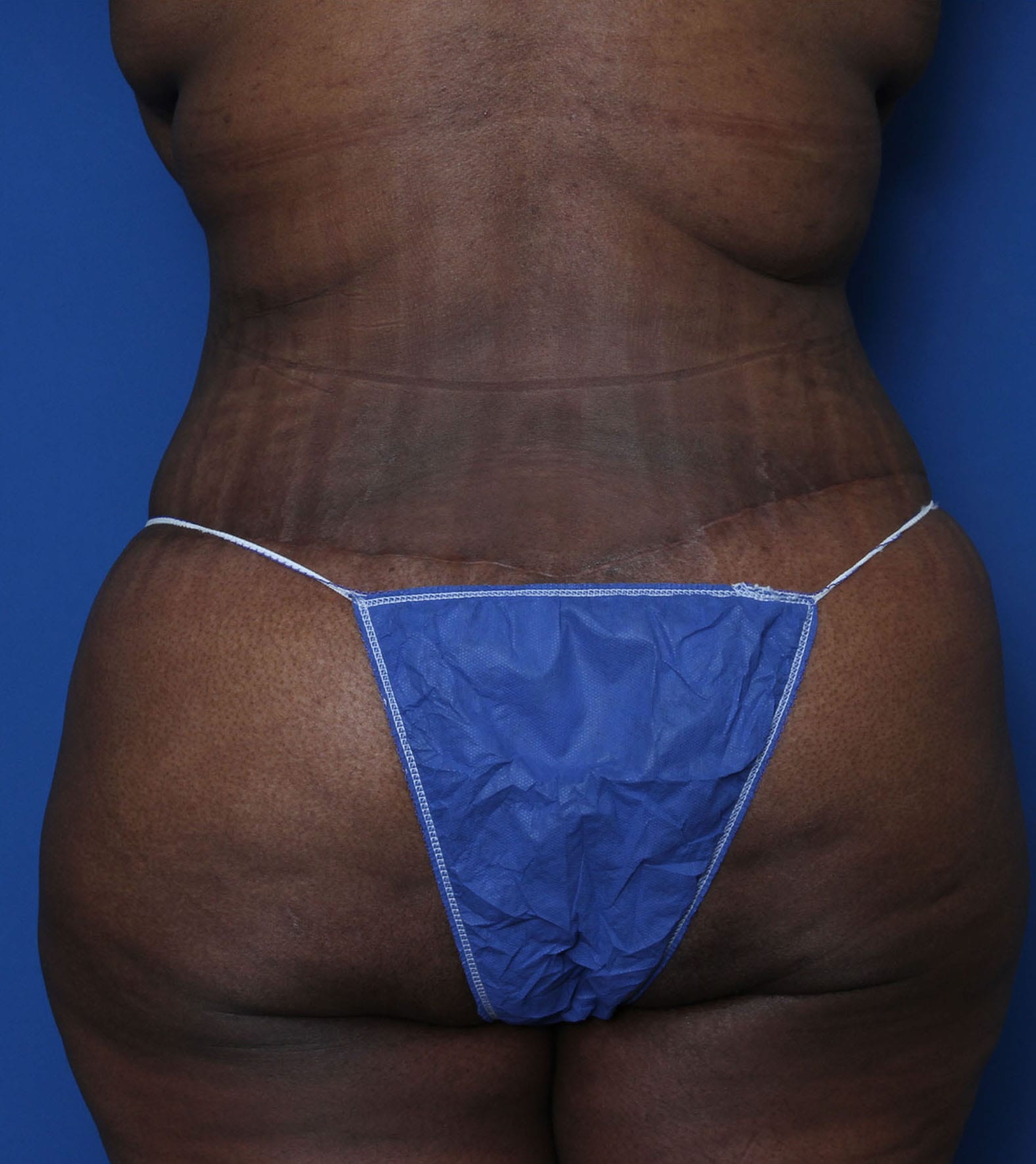Belt Lipectomy Patient Photo - Case MM1110 - after view-3