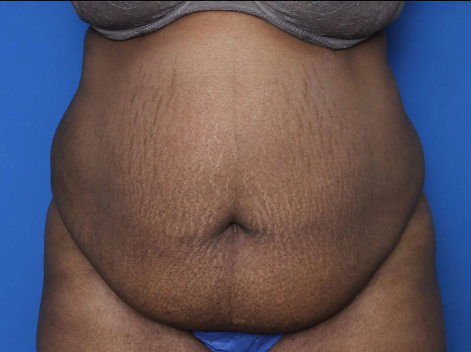 Belt Lipectomy Patient Photo - Case MM1110 - before view-