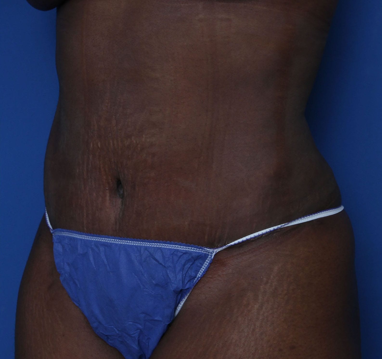 Tummy Tuck Patient Photo - Case MM5966 - after view-0