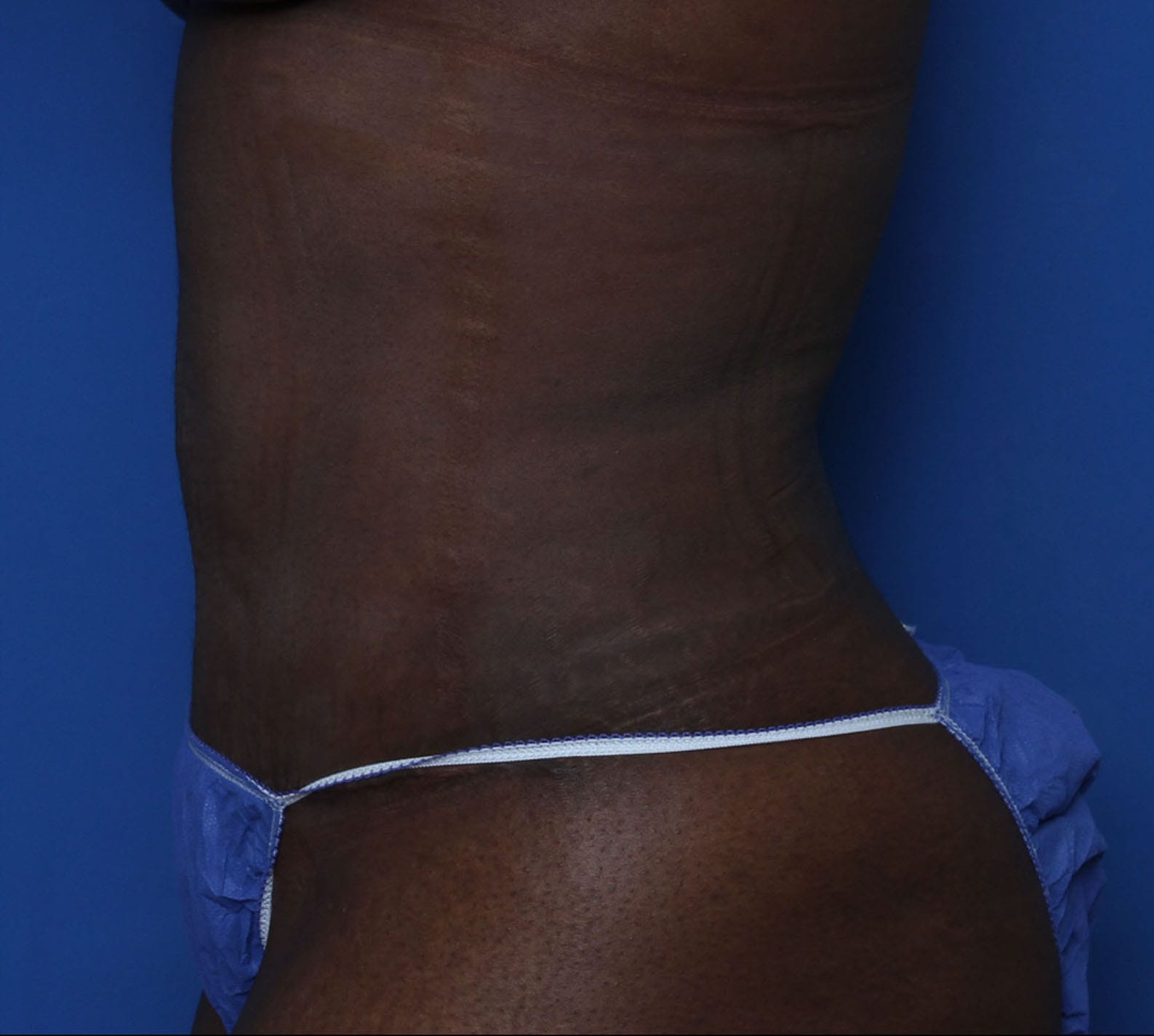 Tummy Tuck Patient Photo - Case MM5966 - after view-1