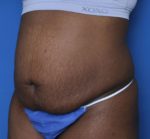 Tummy Tuck - Case MM5966 - Before