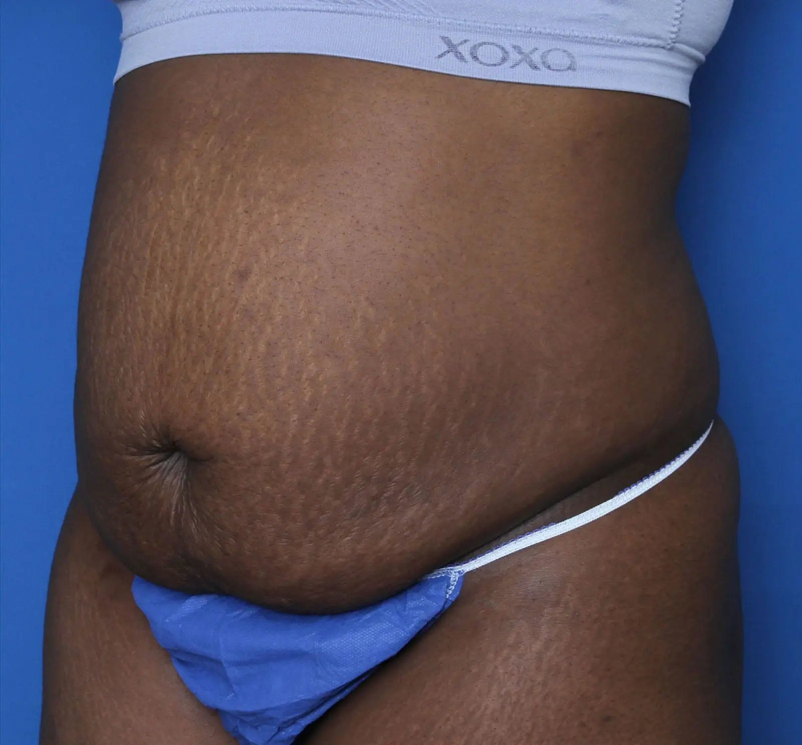 Tummy Tuck Patient Photo - Case MM5966 - before view-0