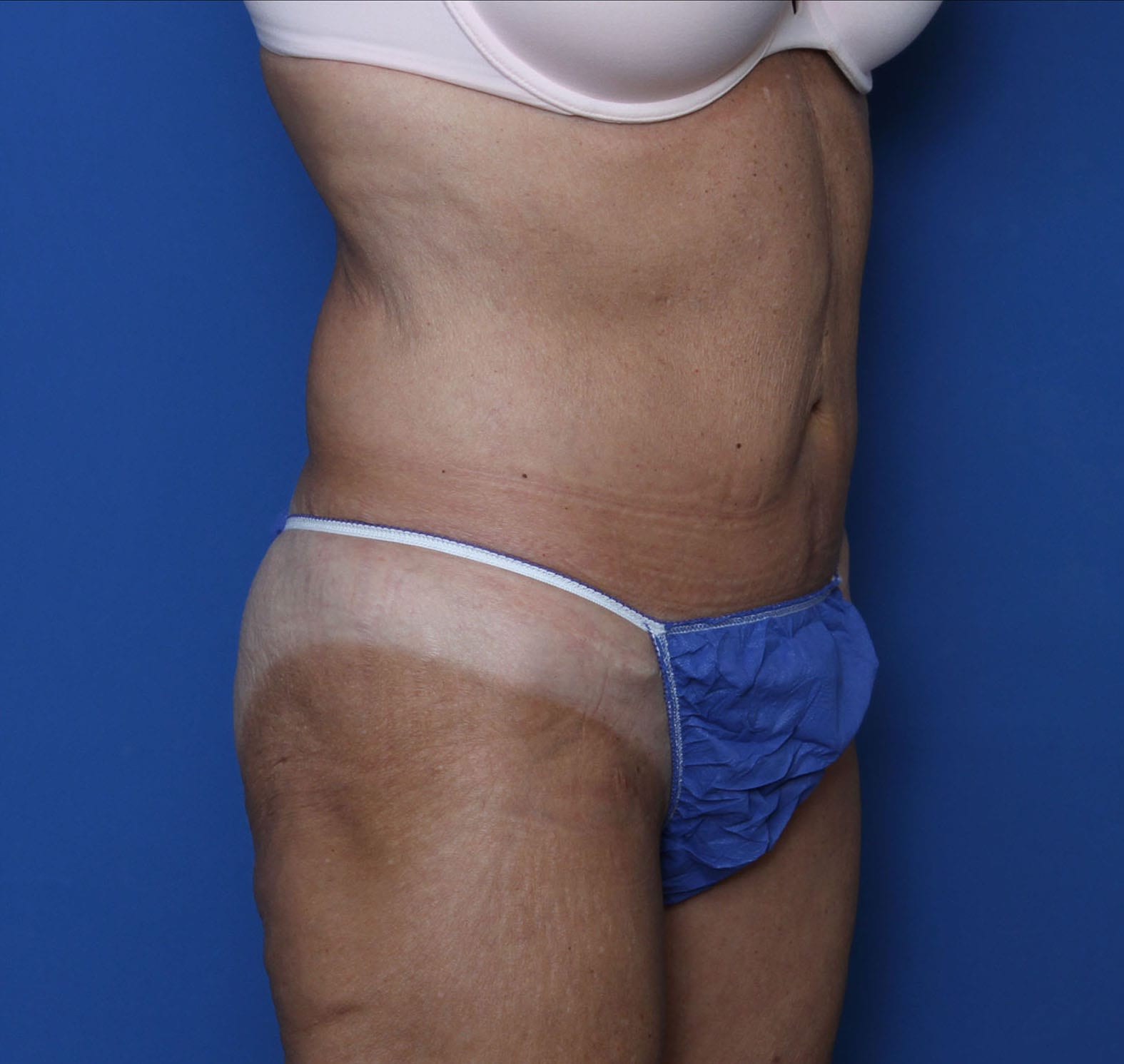 Belt Lipectomy Patient Photo - Case MM2551 - before view-1