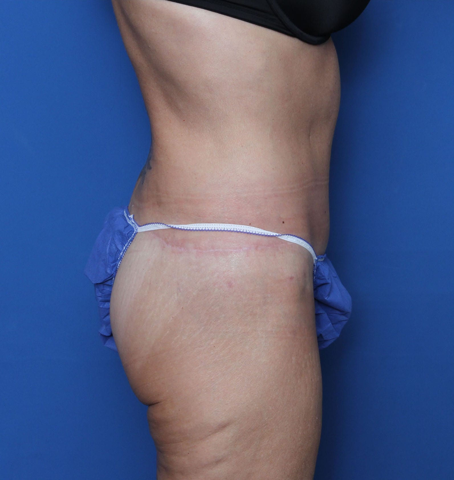 Belt Lipectomy Patient Photo - Case MM2551 - after view-2