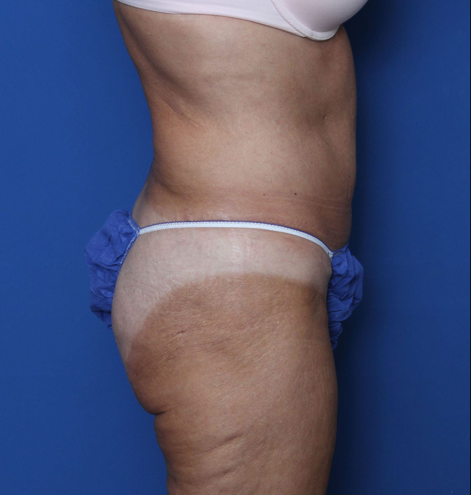 Belt Lipectomy Patient Photo - Case MM2551 - before view-2