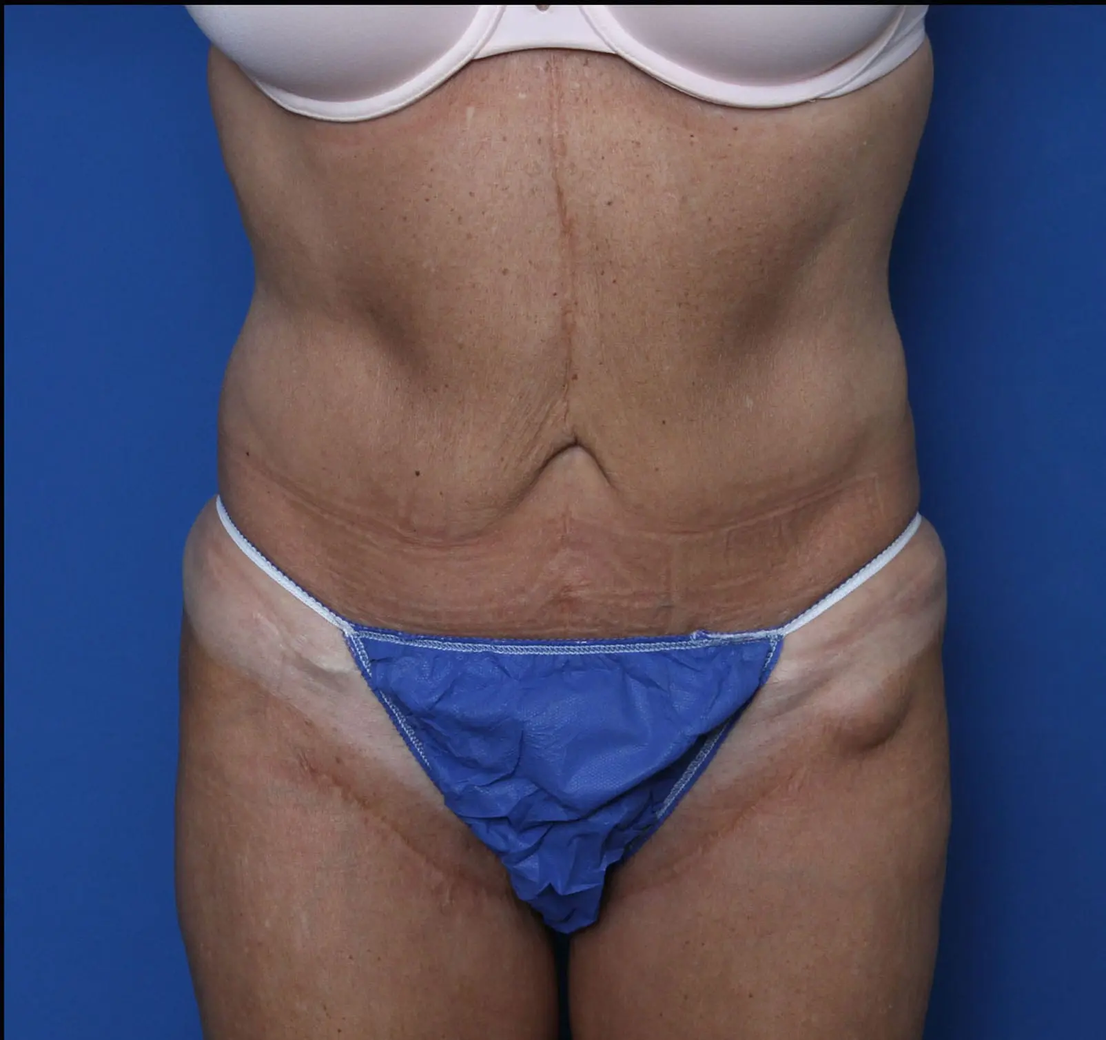 Belt Lipectomy Patient Photo - Case MM2551 - before view-