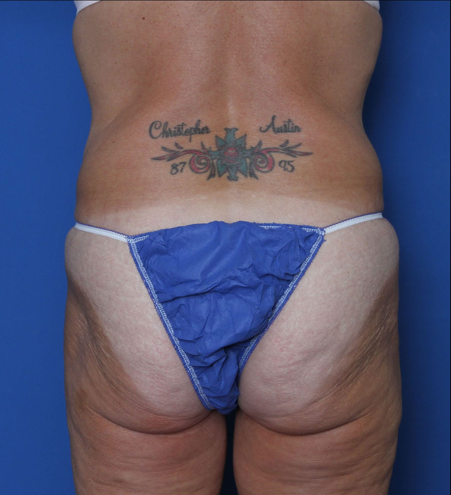 Belt Lipectomy Patient Photo - Case MM2551 - before view-3