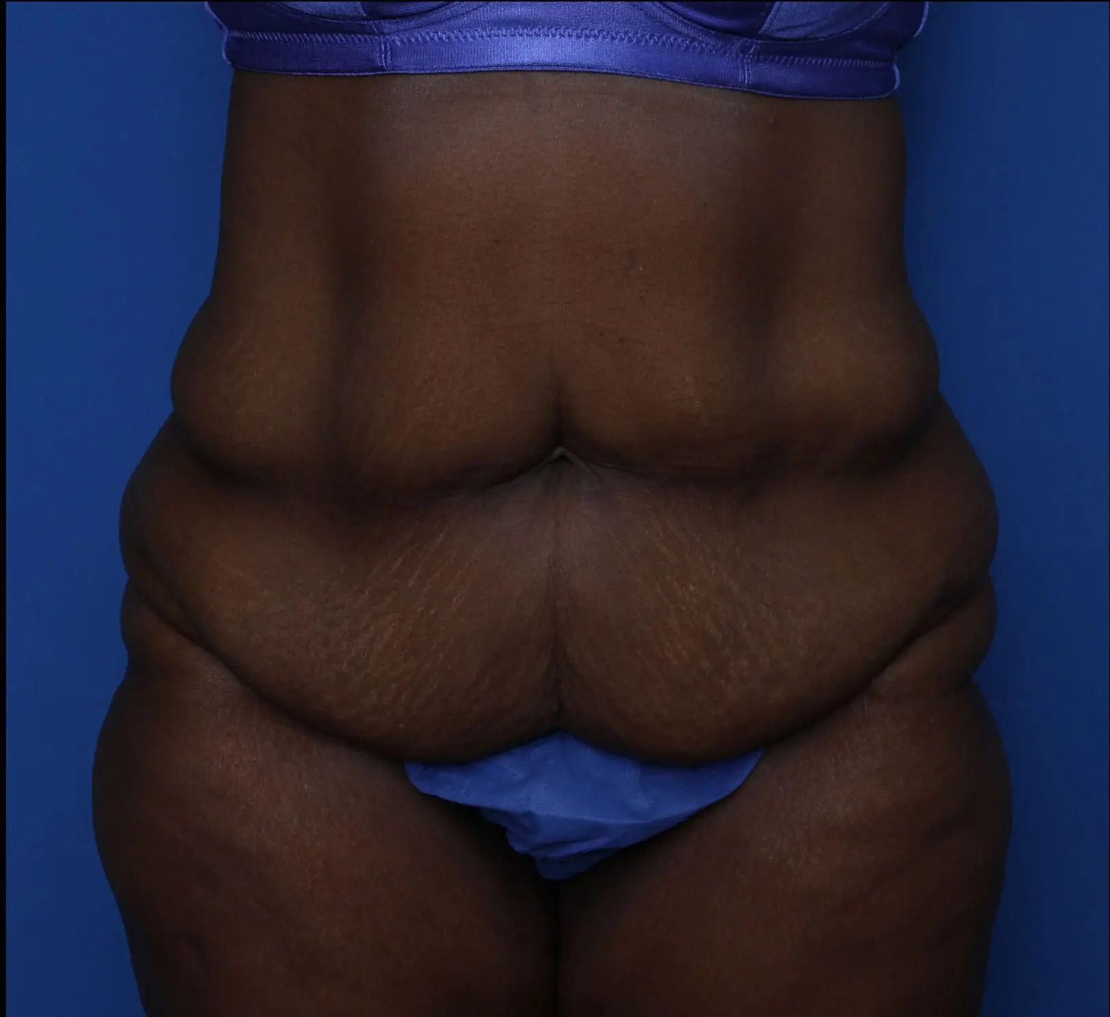 Belt Lipectomy Patient Photo - Case MM5930 - before view-