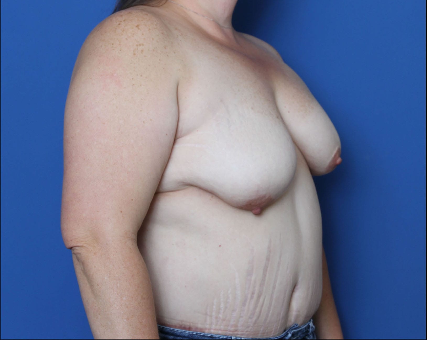 Breast Lift Patient Photo - Case 6708 - before view-2